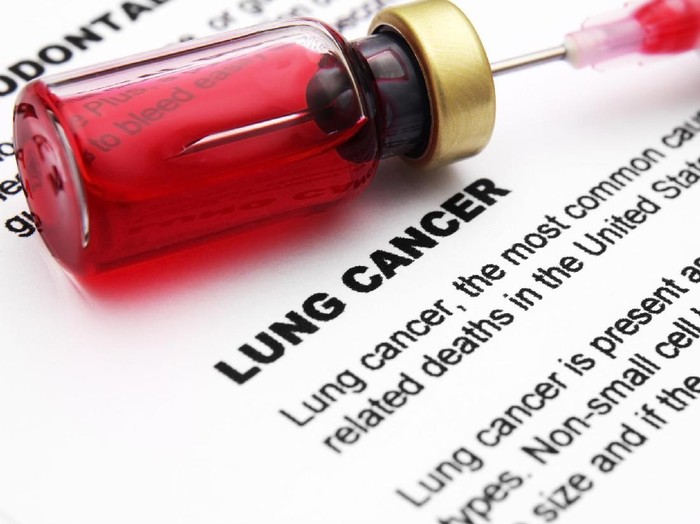 Memahami Kaitan Paparan Radon dengan Risiko Kanker Paru