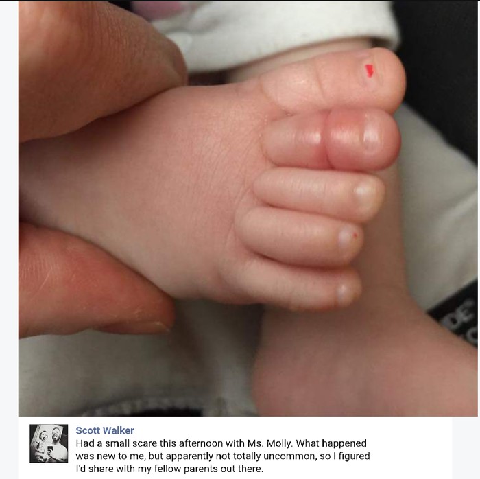 Hair Torniquet Syndrome, Saat Sehelai Rambut Hambat Aliran Darah Anak