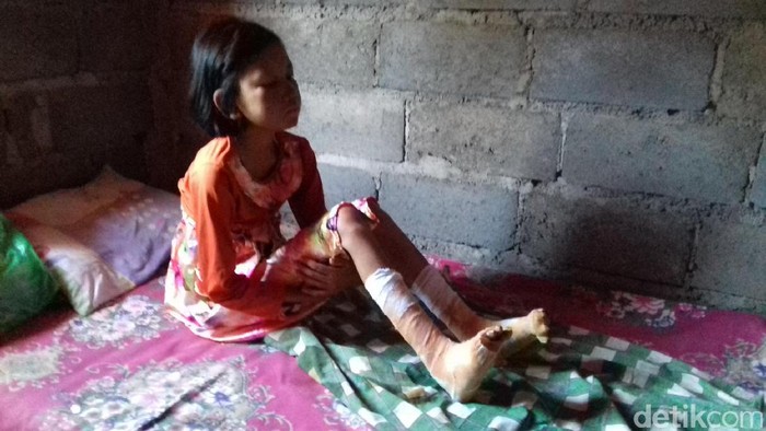 Kisah Bocah yang Kakinya Melepuh Hingga Tak Bisa Berjalan
