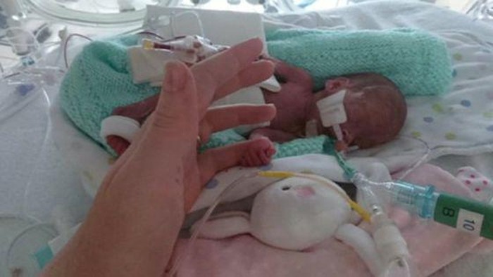 Abiageal, Bayi Termuda yang Survive Pasca Dibedah Perutnya