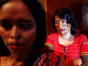 Ketika Wanita Berwajah Melepuh Korban Siraman Air Keras Jadi Model