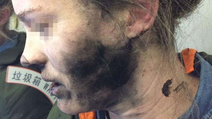 Wanita Ini Mengalami Luka Bakar Karena Headphone di Pesawat