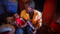Anak-anak kekurangan gizi akibat kekeringan dan kelaparan. The International Federation of Red Cross and Red Crescent Societies/Reuters.