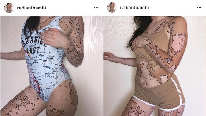 Saat Belang di Kulit Akibat Vitiligo Menjadi Seni yang Indah