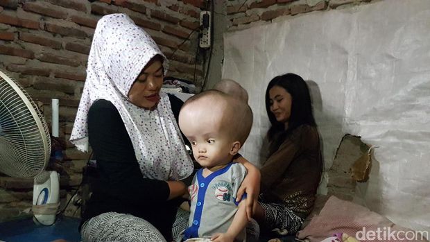 Ilham Bocah Penderita Hidrosefalus di Serang Butuh Bantuan