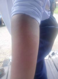 Tangan siswa yang memar akibat pemukulan yang dilakukan oleh Sumiyati. 