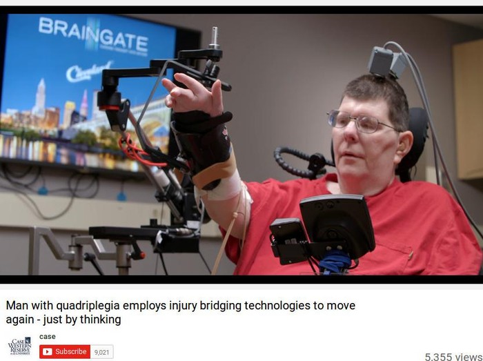 8 Tahun Lumpuh, Pria Ini Bisa Gerak Lagi dengan Kekuatan Pikiran