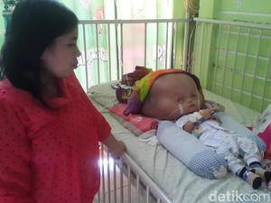 Kepala Makin Membesar, Balita di Banyuwangi ini Butuh Bantuan