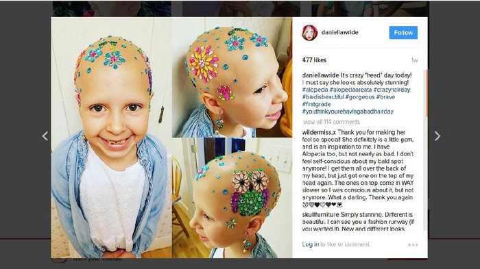 Meski Gundul karena Sakit, Bocah Ini Semangat Ikuti Crazy Hair Day