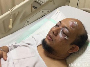 Penyiraman Air Keras ke Novel Teror Biadab, Polri Harus Usut