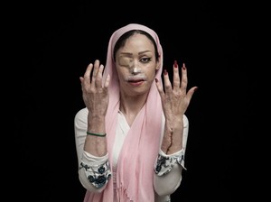 Potret Korban Serangan Air Keras Pemenang Sony World Photography Awards