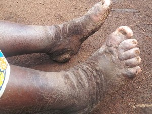 Podoconiosis, Penyakit Kaki Gajah Langka karena Sering Jalan Tanpa Alas