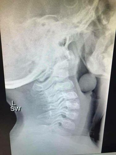 Foto X-ray Anggur Tersangkut di Kerongkongan Anak Ini Jadi Viral