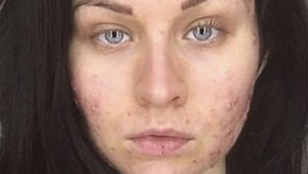 Jerawat juga bisa muncul karena stres.