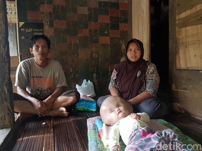 Kisah Bayi Hidrosefalus Asal Serang yang Divonis Tak akan Sembuh