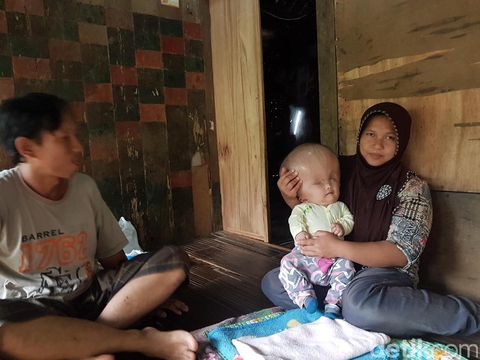 Kisah Bayi Hidrosefalus Asal Serang yang Divonis Tak Akan Sembuh