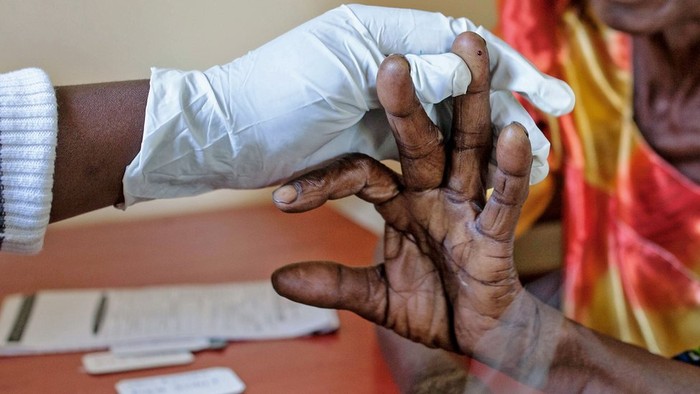 Tiga Negara Lakukan Vaksinasi Massal Malaria Pertama di Dunia