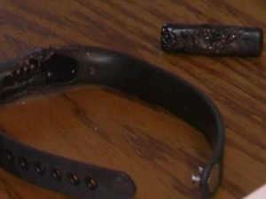 Gelang Pintarnya Meledak, Wanita Ini Luka Bakar Parah