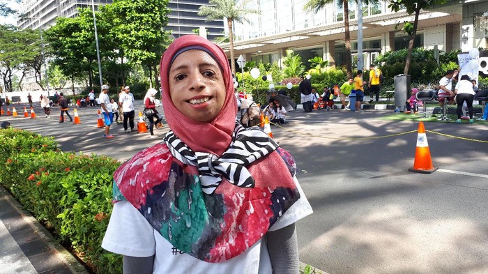 Kisah Lisa, Pengidap Sindrom Langka yang Kini Jadi Guru di Bekasi