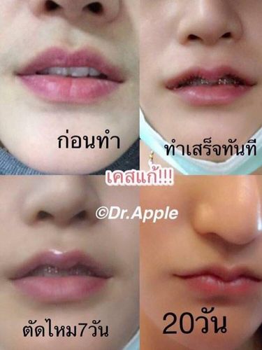  Tren di Thailand, Wanita Operasi Bibir Agar Mirip Tanduk Kerbau