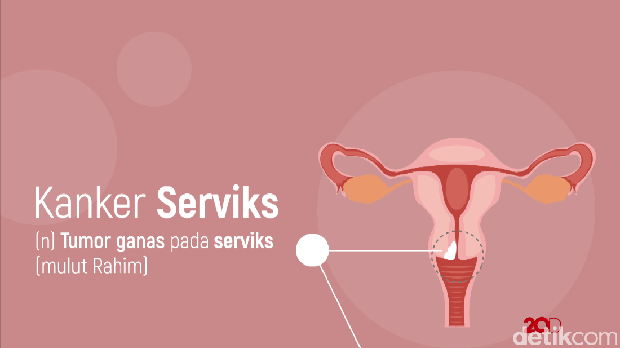 Kanker serviks bisa dideteksi dengan papsmear dan IVA (Inspeksi Visual Asam Asetat)