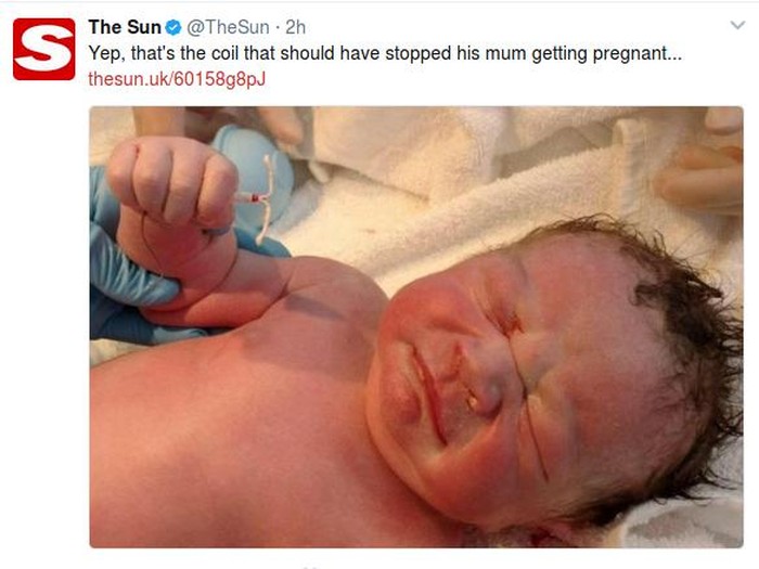 Unik! Saat Lahir Bayi Ini Genggam IUD Ibunya yang Hilang