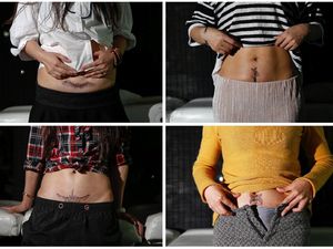 Tato Gratis untuk Kaum Ibu yang Punya Bekas Luka Caesar