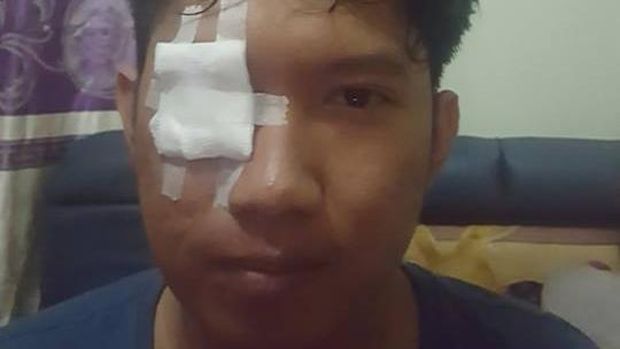 Lagi Asyik Motoran, Mata Rendhy Terkena Bara Rokok Pengendara Lain