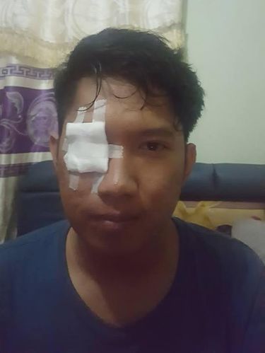 Rendhy yang matanya terkena bara rokok ketika sedang berkendara.