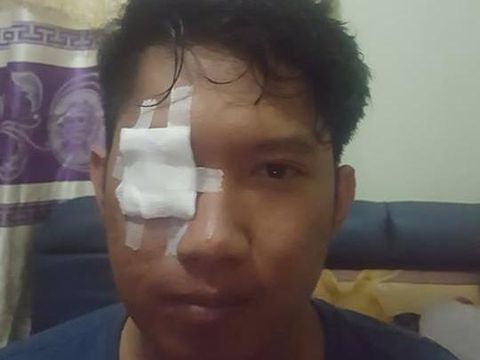 Rendhy Maulana mengalami iritasi pada mata akibat bara rokok 