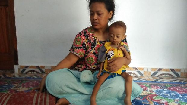 Kisah Dafa, Balita Pengidap Gizi Buruk di Cilegon