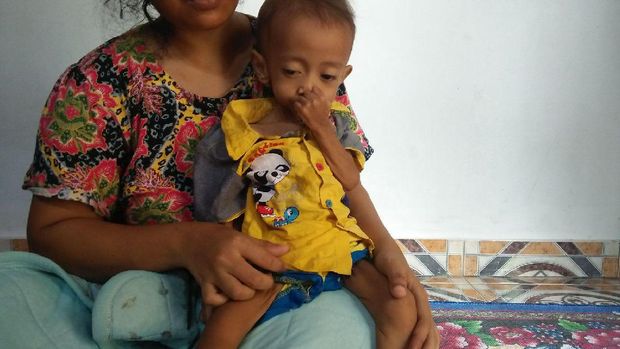 Kisah Dafa, Balita Pengidap Gizi Buruk di Cilegon