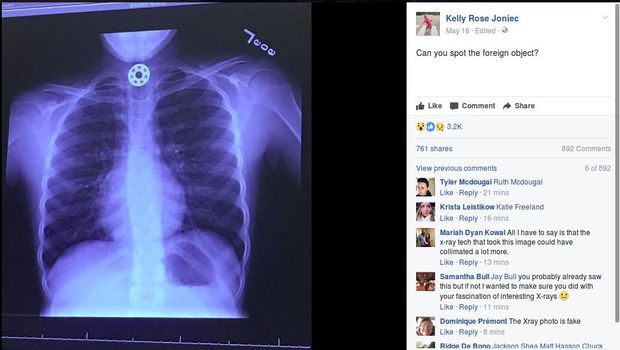 Hati-hati, Bagian Fidget Spinner Ini Bisa Bikin Tersedak