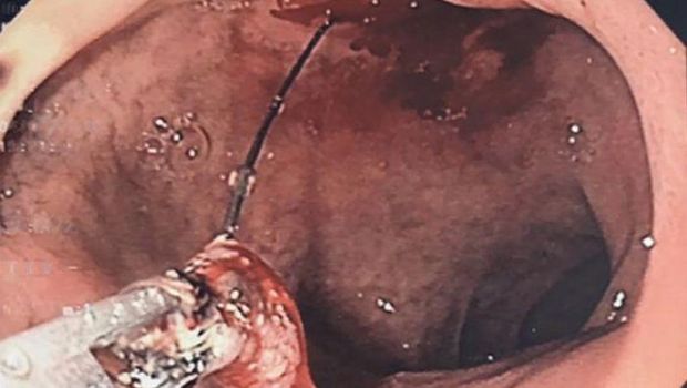 Kawat dari bagian sikat yang tertelan