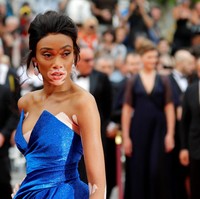 Kondisi kulit vitiligo tidak menghentikan kiprah Winnie Harlow sebagai model papan atas. Justru kulitnya yang belang-belang menjadi keunikan tersendiri. Model asal Kanada ini pernah tampil di sampul majalah Vogue Italia, Ukraina dan Australia. Ia juga eksis di video klip Beyonce yang berjudul Lemonade.  Foto: REUTERS/Regis Duvignau