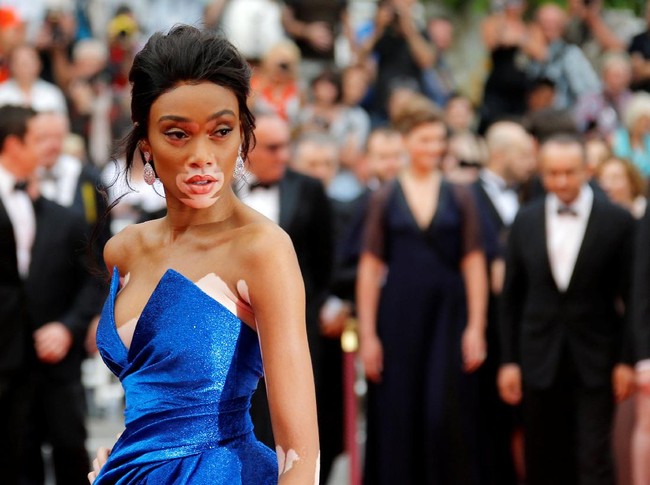 Kondisi kulit vitiligo tidak menghentikan kiprah Winnie Harlow sebagai model papan atas. Justru kulitnya yang belang-belang menjadi keunikan tersendiri. Model asal Kanada ini pernah tampil di sampul majalah Vogue Italia, Ukraina dan Australia. Ia juga eksis di video klip Beyonce yang berjudul Lemonade.  Foto: REUTERS/Regis Duvignau