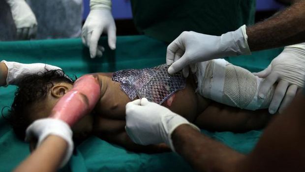 Operasi penggunaan kulit ikan untuk mengobati luka bakar