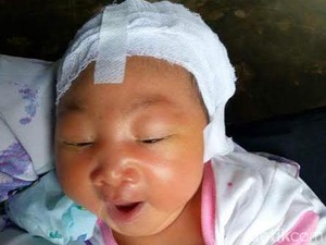 Pemkab Rembang Bantu Biaya Operasi Bayi dengan Tengkorak Berlubang