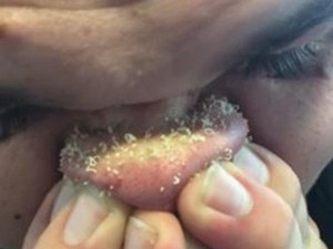 Viral, Video Pria yang Pencet Komedo di Hidung Secara Ekstrem