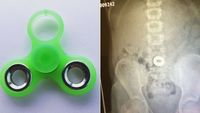 Terjadi Lagi, Gadis di Indiana Tersedak Fidget Spinner