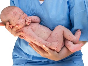 Apakah Rubella Bisa Ditularkan Melalui ASI?