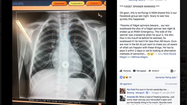 Seorang bocah di Sydney tanpa sengaja menelan komponen fidget spinner