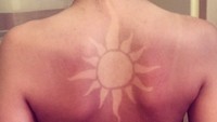 Tren ini disebut sebagai sunburn art. Beberapa orang menyamakannya sebagai pengganti tato namun dengan menggunakan luka bakar. (Foto: Instagram/lotjeeuser)