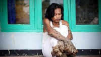 Salah satu penyandang sindrom manusia pohon yang terkenal adalah Dede Koswara dari Indonesia. Ia beberapa kali menjalani operasi pengangkatan tumor hingga pada tahun 2016 lalu meninggal dunia karena komplikasi. (Foto: Gettyimages)