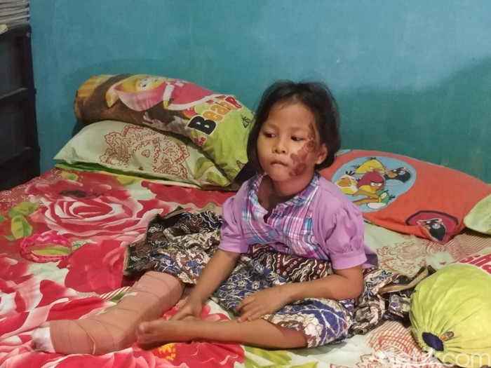 Kaki Retak Terlindas BMW, Amanda tak Trauma