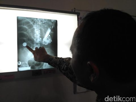 Ini Penampakan Benda Aneh di dalam Perut Pria Situbondo