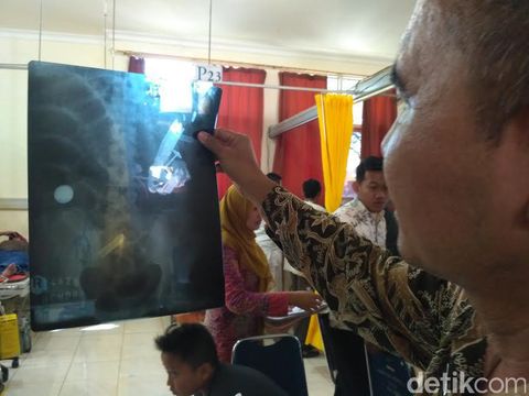 Benda mirip paku dan pisau di perut Hendro/