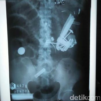 Hasil rontgen saat di rumah sakit Situbondo/