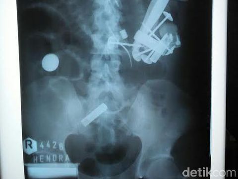 52 benda asing bersarang di perut Hendro