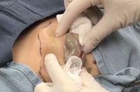 Video Pencet Jerawat Sebesar Bola Pimpong Jadi Viral